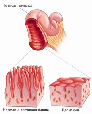 Заболевание целиакия - это непереносимость организмом сложного белка глютен.